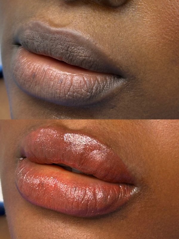 Lip Neutralization